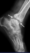 <p>Normal Rx</p><ul><li><p>Intraarticular effusion </p></li><li><p>Periarticular OP</p></li><li><p>Joint space narrowing</p></li><li><p>Blurred cortical bone</p></li><li><p>Subcondral bone destruction</p></li><li><p>Erosion + osteomyelitis</p></li><li><p>Ankylosis (rare)</p></li></ul><p></p>