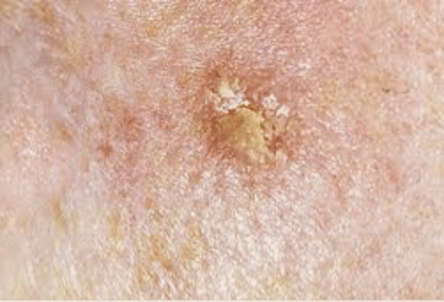 <p>name this skin condition</p>