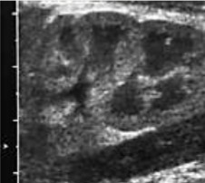 <p>Is the kidney imaged from an adult, child, neonate, or fetus?</p>