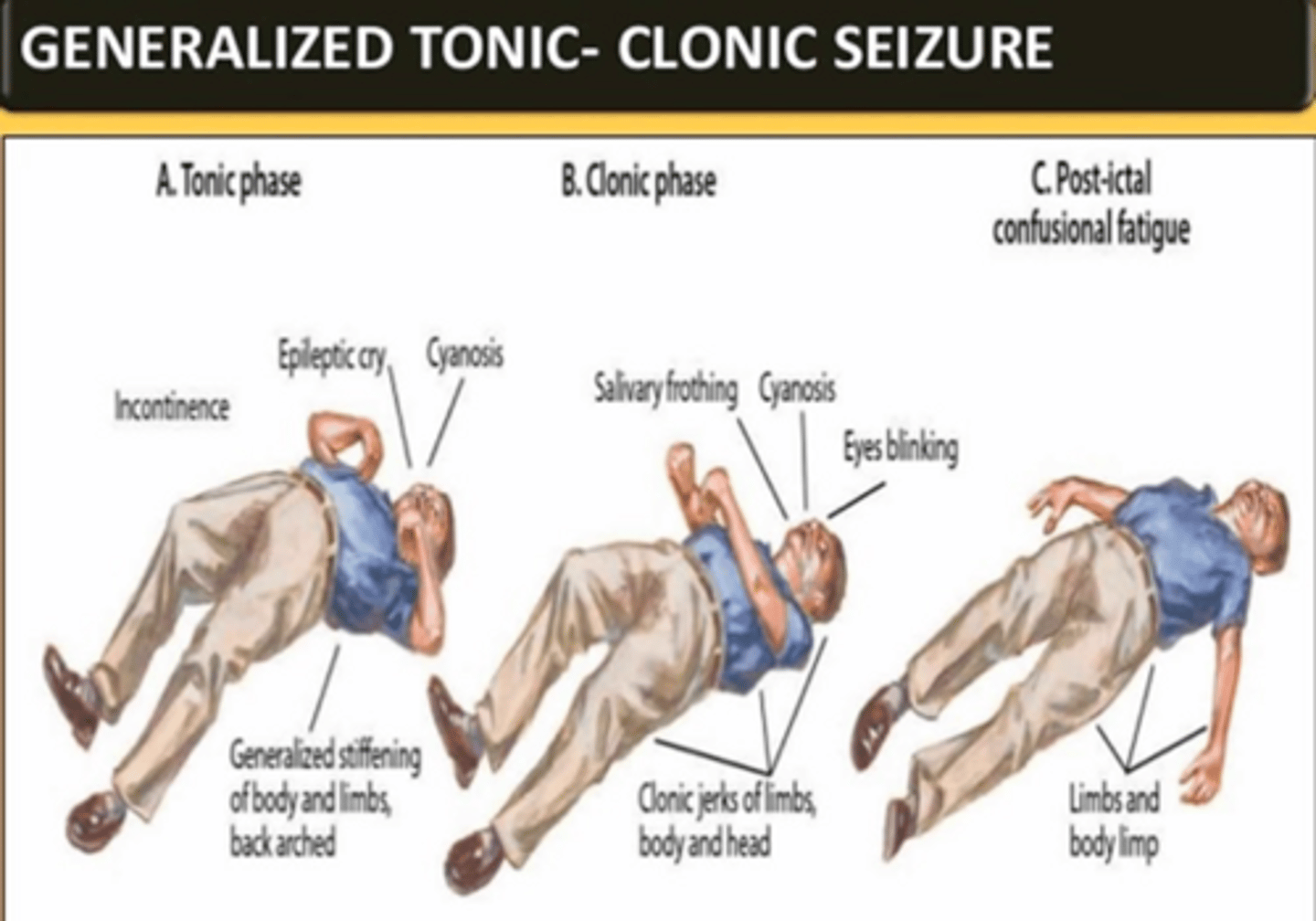 <p>1. Tonic phase (20 sec -1 minute)</p><p>2. Clonic phase (30 to 90 seconds)</p><p>3. Post-ictal</p>