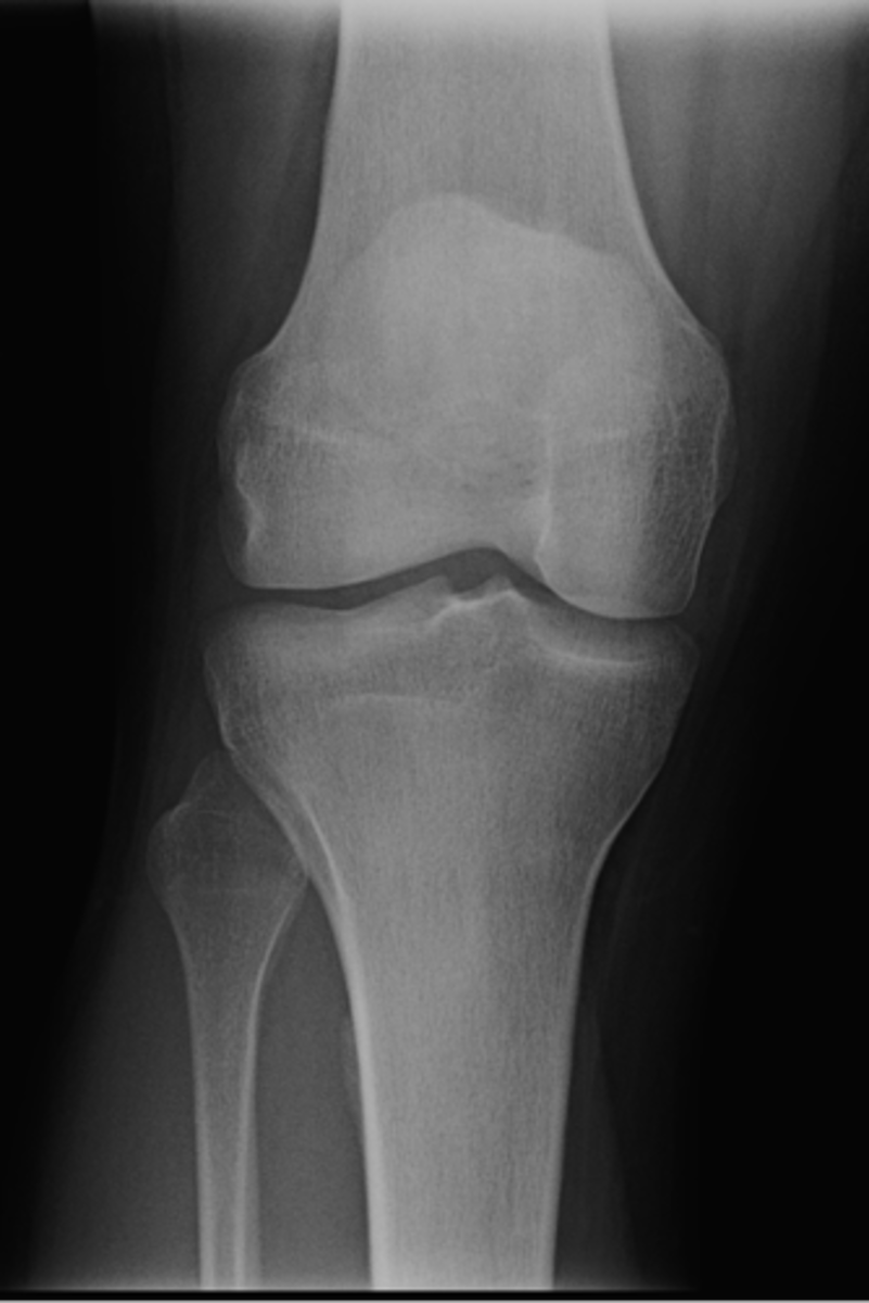 <p>ID standard knee projection</p>