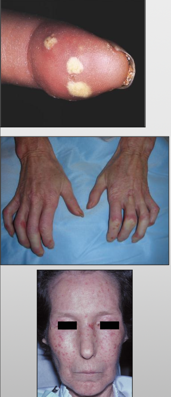 <p>C-calcinosis- calcium deposits in the skin</p><p>R-Raynaud’s phenomenon-spasm of blood vessels in response to cold or stress</p><p>E-esophageal dysfunction, acid reflux and decrease in motility of esophagus</p><p>S-sclerodactyly-thickening and tightening of the skin on the fingers and hands</p><p>T-telangiectasis- dilation of capillaries causing red marks on surface of skin</p>