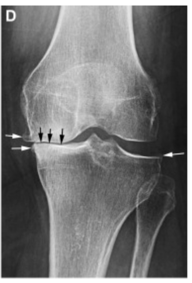 <p>Define the Kelgren Lawrence grade. How do you know?</p>