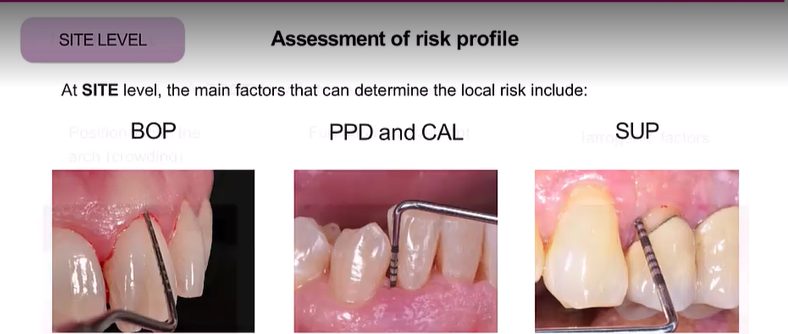 <ol><li><p>BOP No bleeding is a good indicator of stability rather than saying because there is bleeding there is instability</p></li><li><p>PPD and CAL</p></li><li><p>Suppuration&nbsp;</p></li></ol><p> </p>