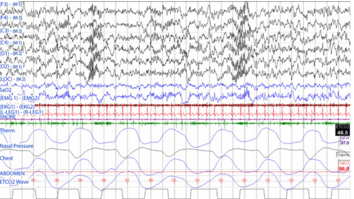 <p>A sleep disorders specialist notes the following epoch while scoring an overnight study of an adult. This should be scored as stage:</p>