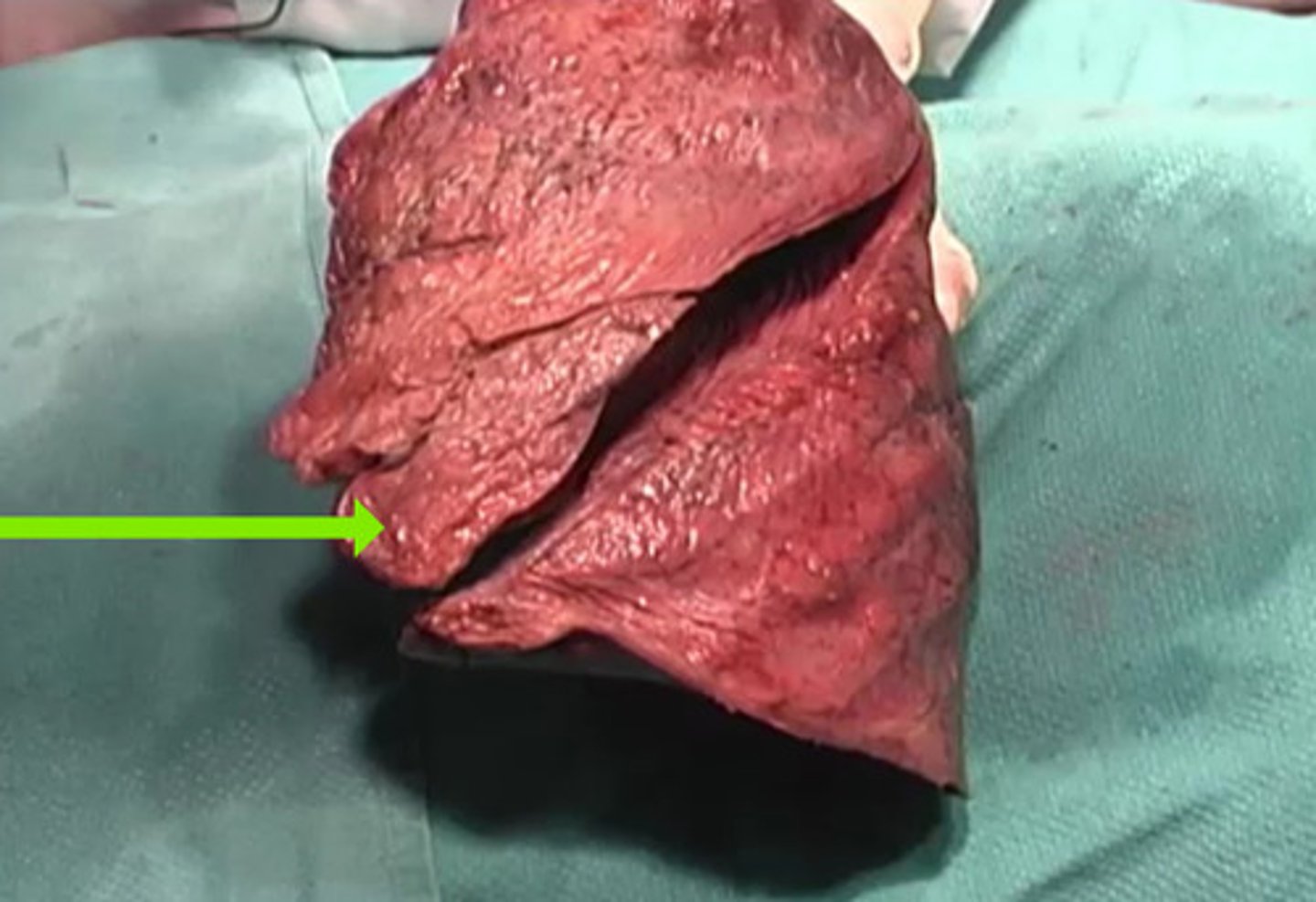 <p>What is this structure?</p><p>lobar</p><p>inferior lobe</p><p>lingula</p><p>middle lobe</p>