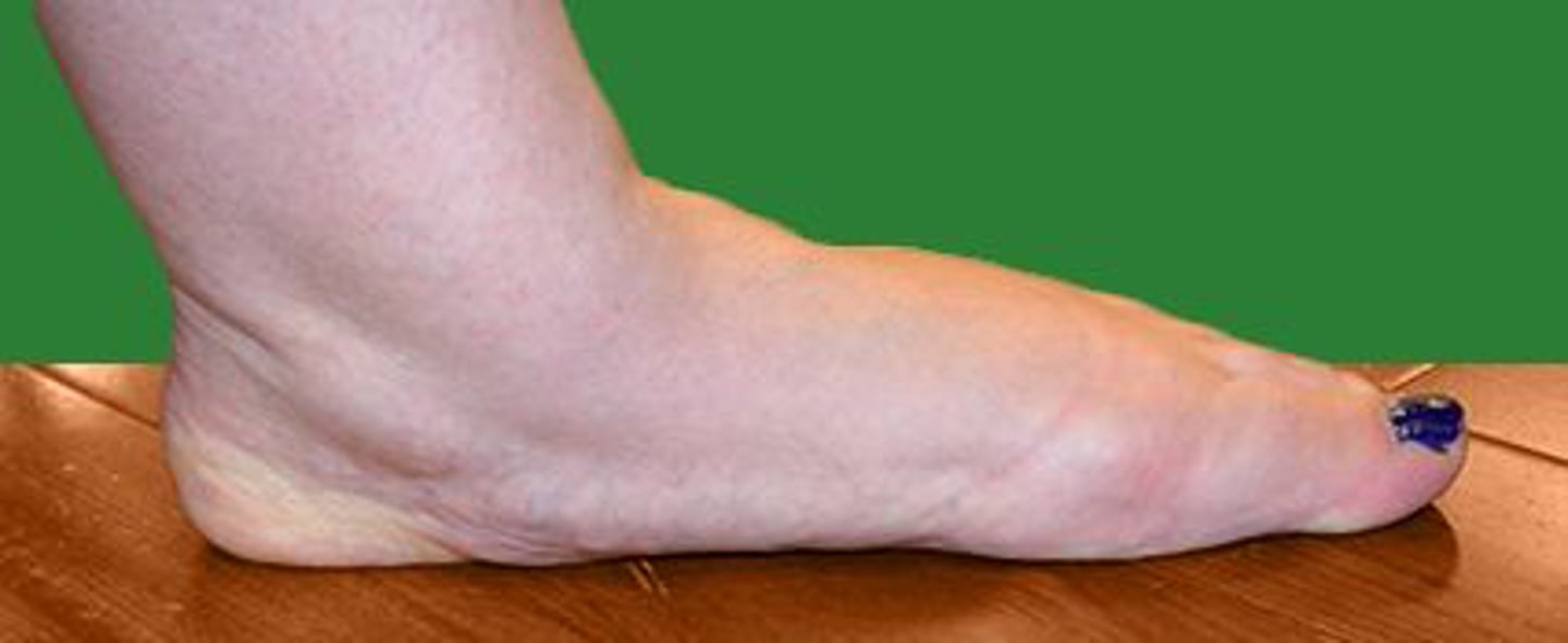 <p>Which of the following terms BEST describes the foot deformity shown in the photograph?</p><p>1. Pes cavus</p><p>2. Pes planus</p><p>3. Equinus foot</p><p>4. Calcaneus foot</p>
