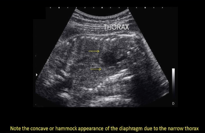 <p>if the radiologist suspects<strong> potter syndrome</strong> + requests that you perform a thoracic circumference. how will this measurement assist in the dx? Potter syndrome usually shows</p><p>.</p><p>a) cardiomegaly + diaphragmatic hernia, which will increase the size of thoracic cavity</p><p>b) pulmonary hyperplasia, which leads to enlarged thorax</p><p>c) a narrow thorax due to acardia</p><p>d) a bell-shaped thorax that is much more narrow than the abd cavity</p>