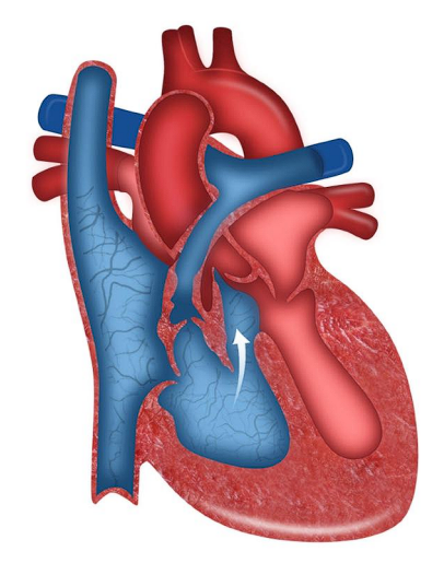 __**● Four defects:**__  

○ Large VSD 

○ Pulmonary stenosis 

○ Right ventricular hypertrophy 

○ Overriding aorta  

__**● History**__  

○ Cyanosis  

○ Dyspnea  

○ Poor feeding and weight gain  

__**● Specific assessment findings:**__  

○ Tet spells  