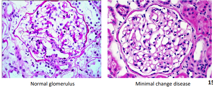 <p>Compare the glomeruli in these light microscopy images:</p><ul><li><p>Open capillaries</p></li><li><p>Sharp glomerular basement membrane</p></li></ul><p></p>