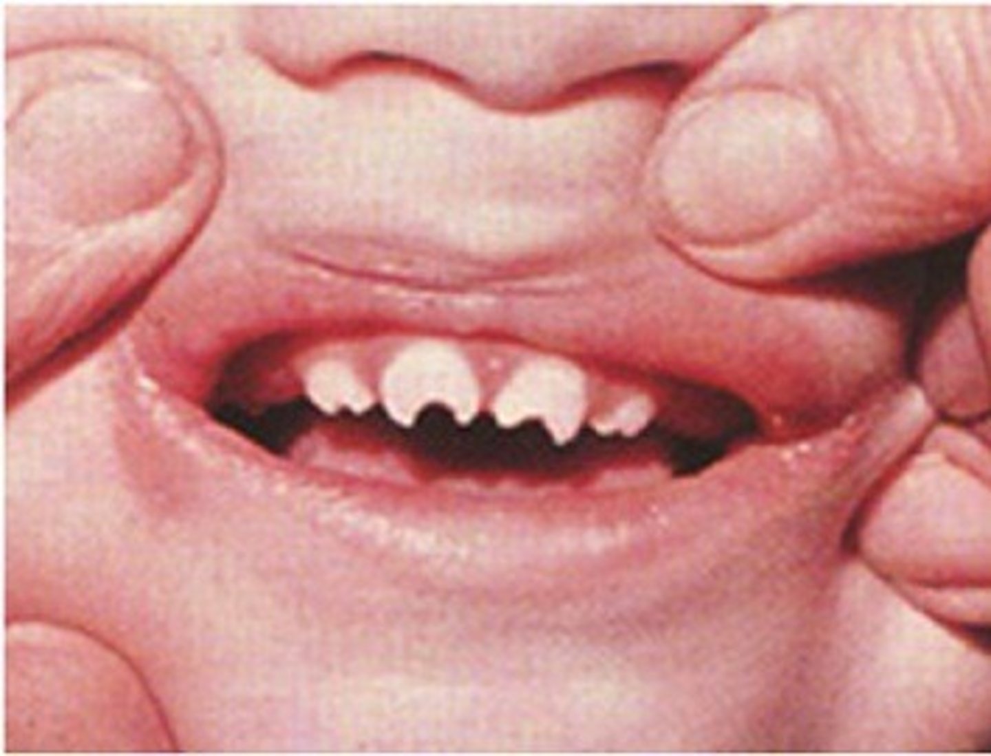 <p>Peg-shaped teeth; seen in congenital syphilis</p>