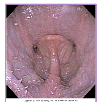 <p>BOAS Elongated soft palate </p>