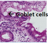 <p>Barrett Esophagus</p>