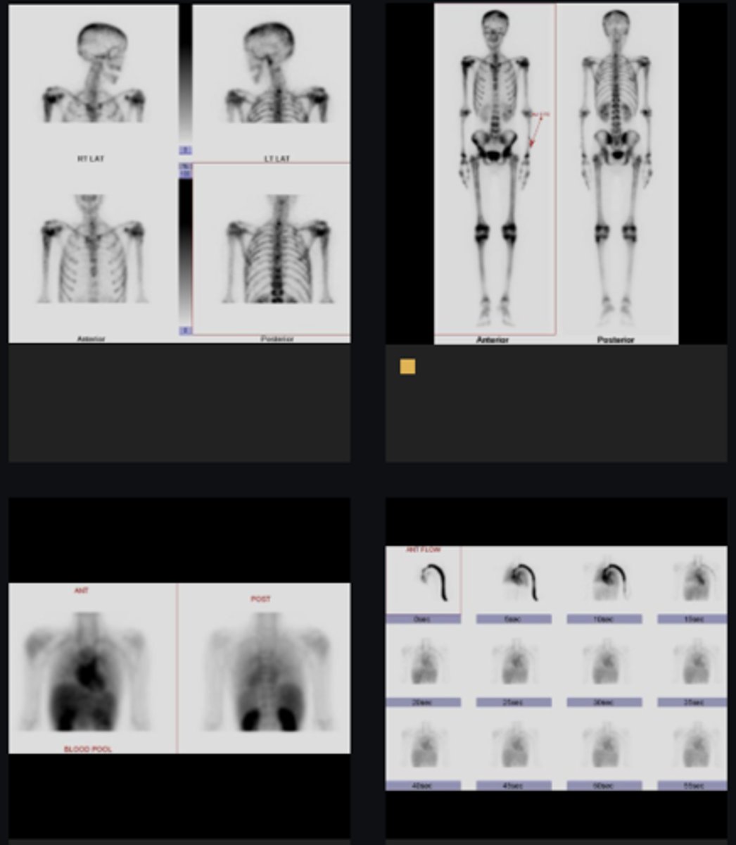 <p>Why do you think they did a bone scan?</p>