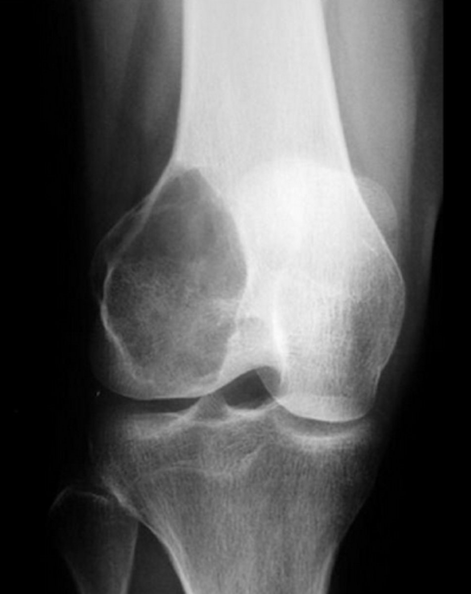 <p>Giant cell tumor of bone</p><p>"soap bubble"</p><p>- benign, locally aggressive</p>