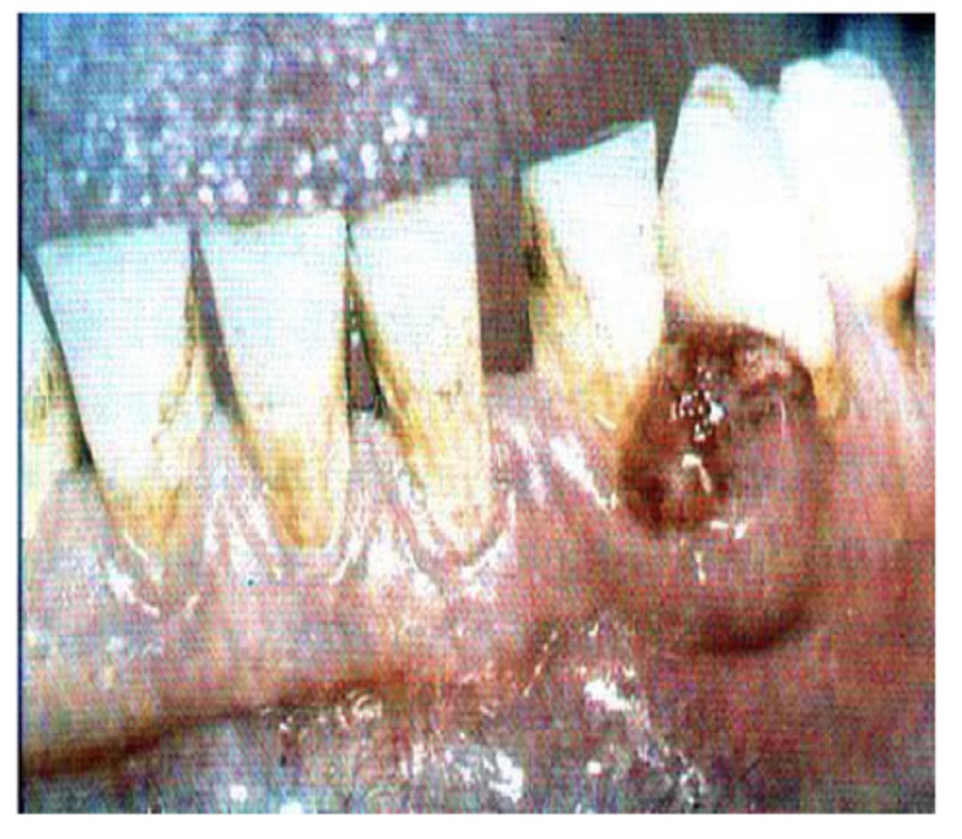 <p>Appears on the gingival margins, ulcerated appearance and is thought to be an over response to irritation - usually excised - what am i ?</p>