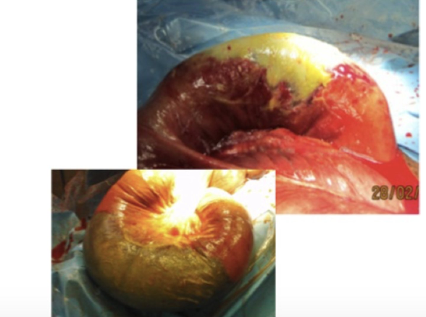 <p>En hest på 6 år har haft mild kolik og feber i nogle dage. Ved indlæggelsen på hospitalet diagnosticeres hesten med peritonitis og der foretages en eksplorativ laparotomi. Hvordan vil du karakterisere denne læsion i flexura pelvina?</p><p>- Strangulerende intestinal nekrose</p><p>- Non-strangulerende intestinal nekrose</p><p>- Non-strangulerende intestinal inflammation</p><p>- Strangulerende intestinal ischæmi</p>