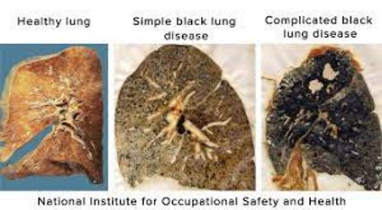 <p><strong>Anthra</strong>cosis/coal miner lung/black lung (type of pneumoconiosis)</p>