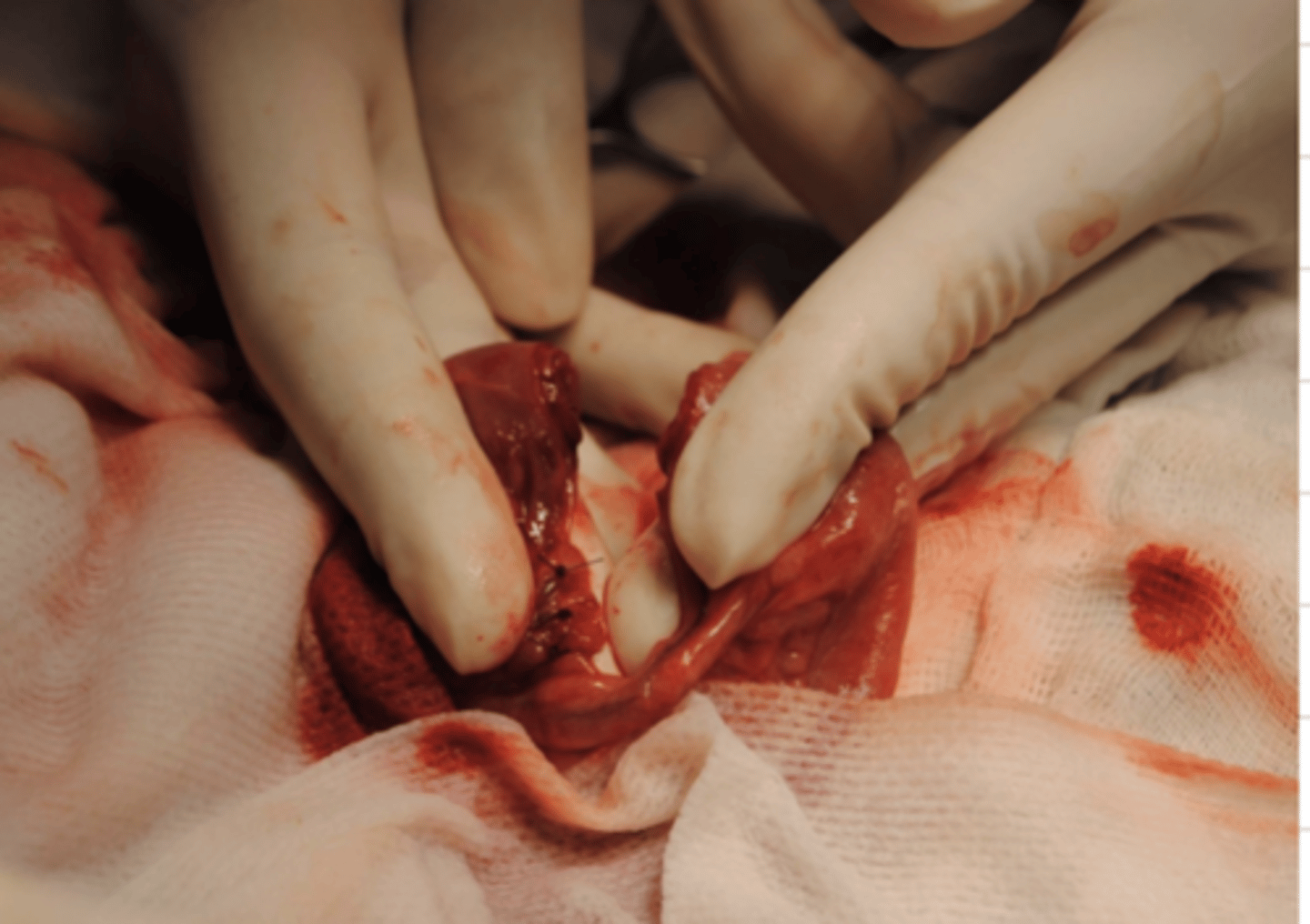 <p>this surgeon is removing the intestines.</p><p>what is the name for this operation?</p>