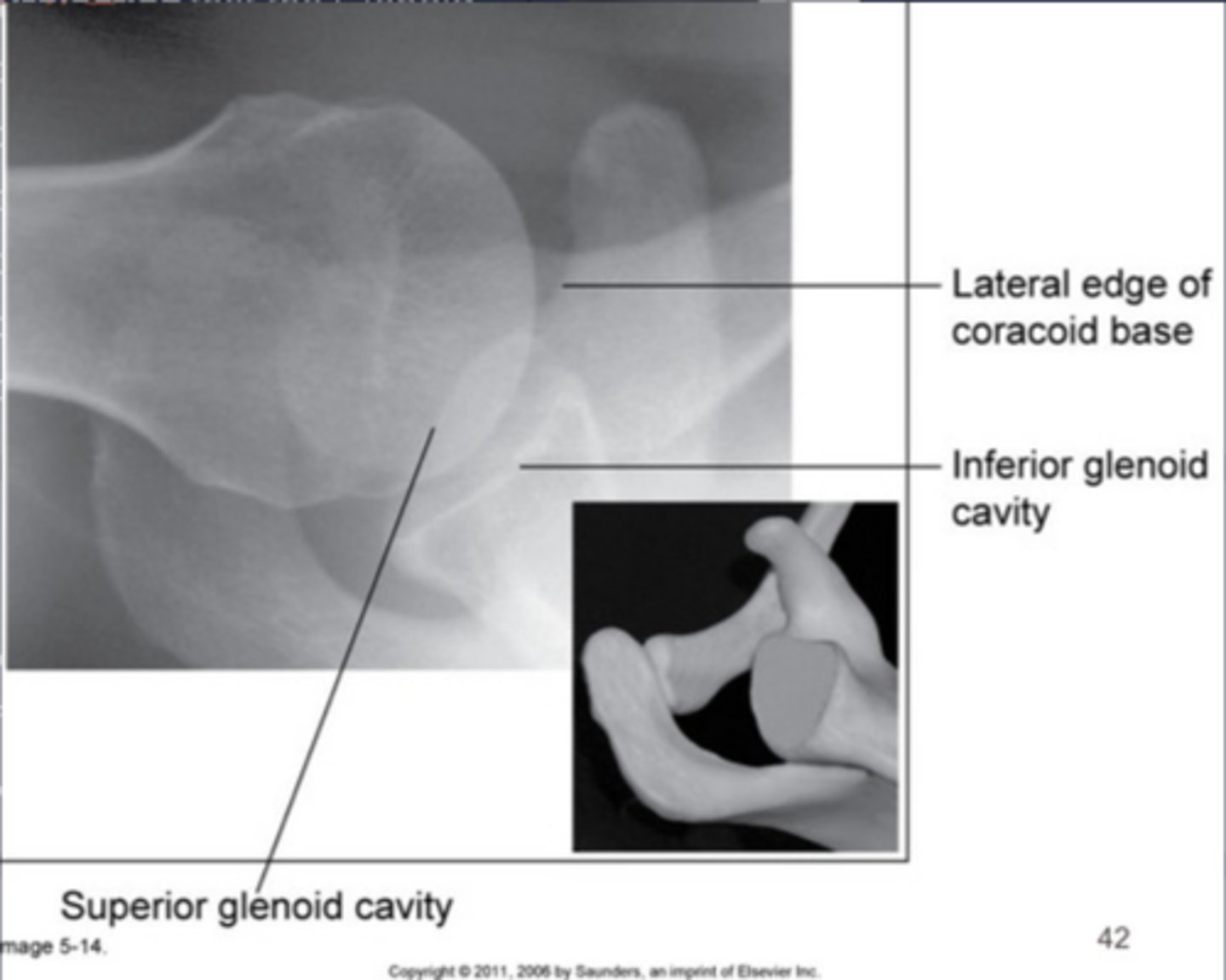<p>Too much CR angle (greater than 30°)</p>