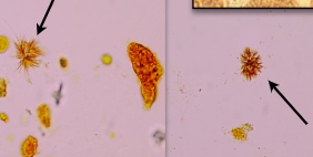 <p>Abnormal</p><ul><li><p>acidic urine</p></li><li><p>soluble in acetic acid, HCl, NaOH, acetone</p></li><li><p>Usually seen in refrigerated urine</p></li><li><p>bilirubin strip should be positive</p></li><li><p>Bilirubin pigement will stain WBC, RBC, etc</p></li></ul><p></p>