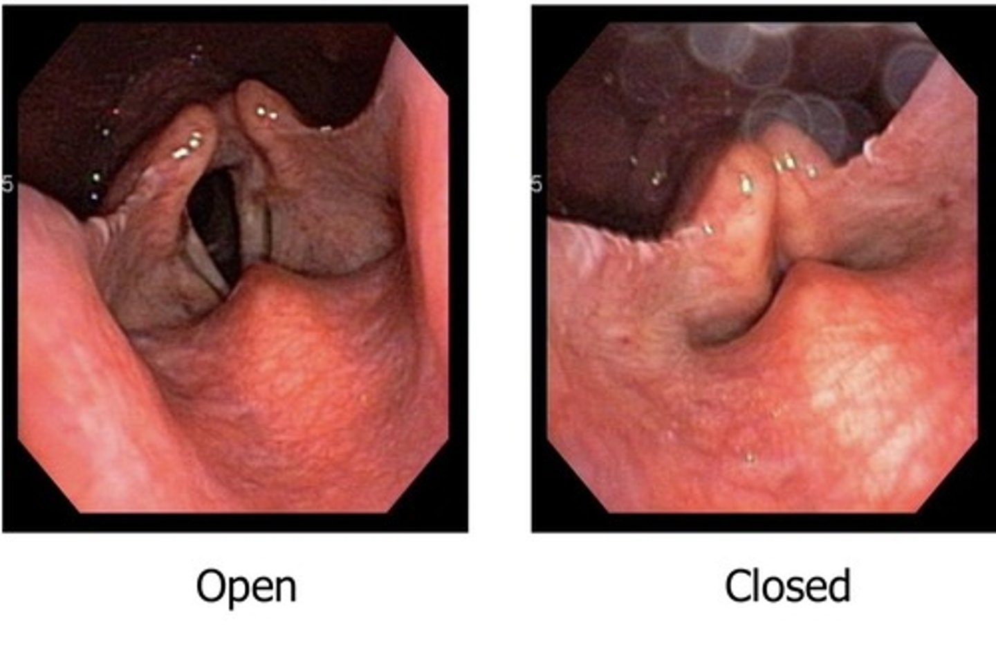 <p>-closes up like drawstring bag due to aryepiglottic muscle<br>-open up due to thyroepiglottic muscle</p>