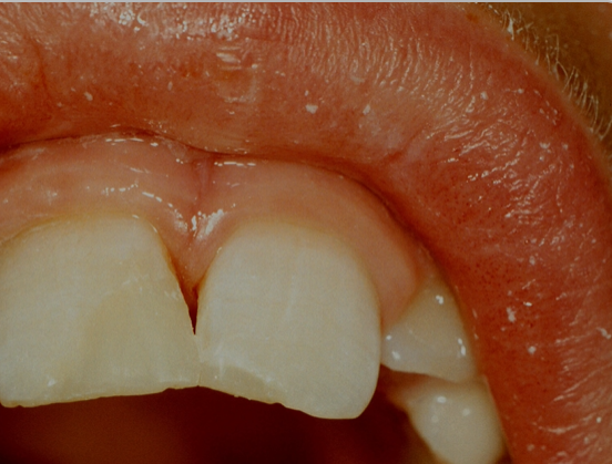 <p>final restoration has good contour </p>