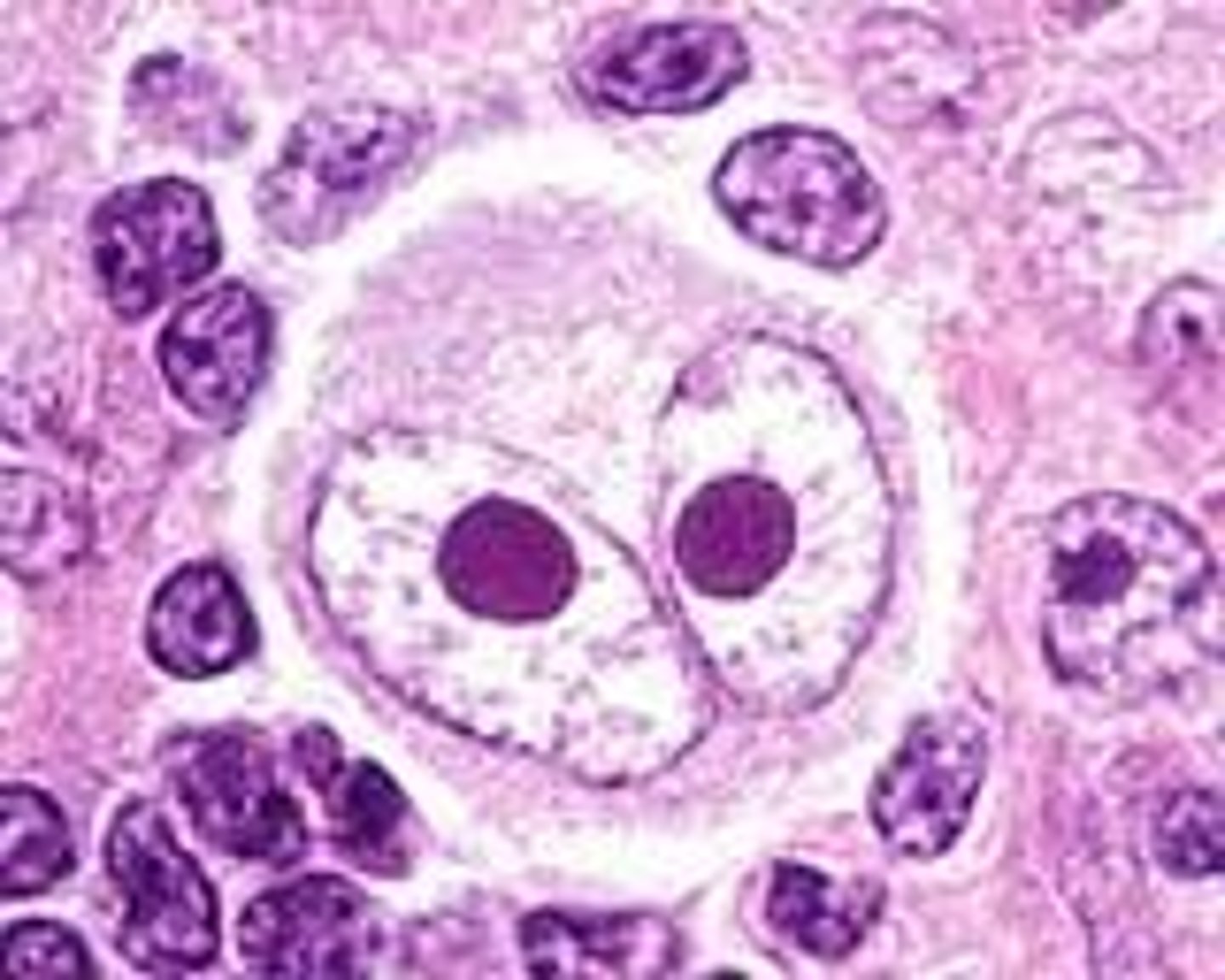 <p>is a malignant lymphoma</p><p>Reed Sternberg cells are the hallmark of HL. Enlarged, painless lymph node in the neck (often the first sign of HL).</p>