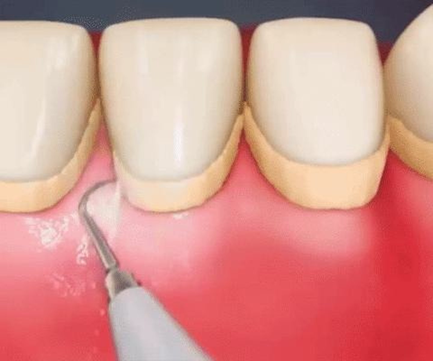 <p>Using measures like educational/DH care to control gingivitis and periodontitis.</p>