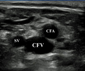<p>What is site 2 for DVT?</p>