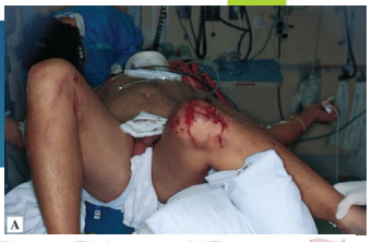 <p><strong>Hip Dislocation: S/S and Diagnosis</strong></p><p>-S/S</p><ul><li><p>_______ hip pain and __________ ROM</p></li><li><p>Posterior → _________, ________ rotated, ___________, flexed extremity </p></li><li><p>Anterior → ___________, _________ rotated, slightly flexed extremity </p></li></ul><p>-Diagnosis</p><ul><li><p>Xray is the initial imaging</p></li><li><p>__/___ are for definitive diagnosis </p></li></ul><p></p>