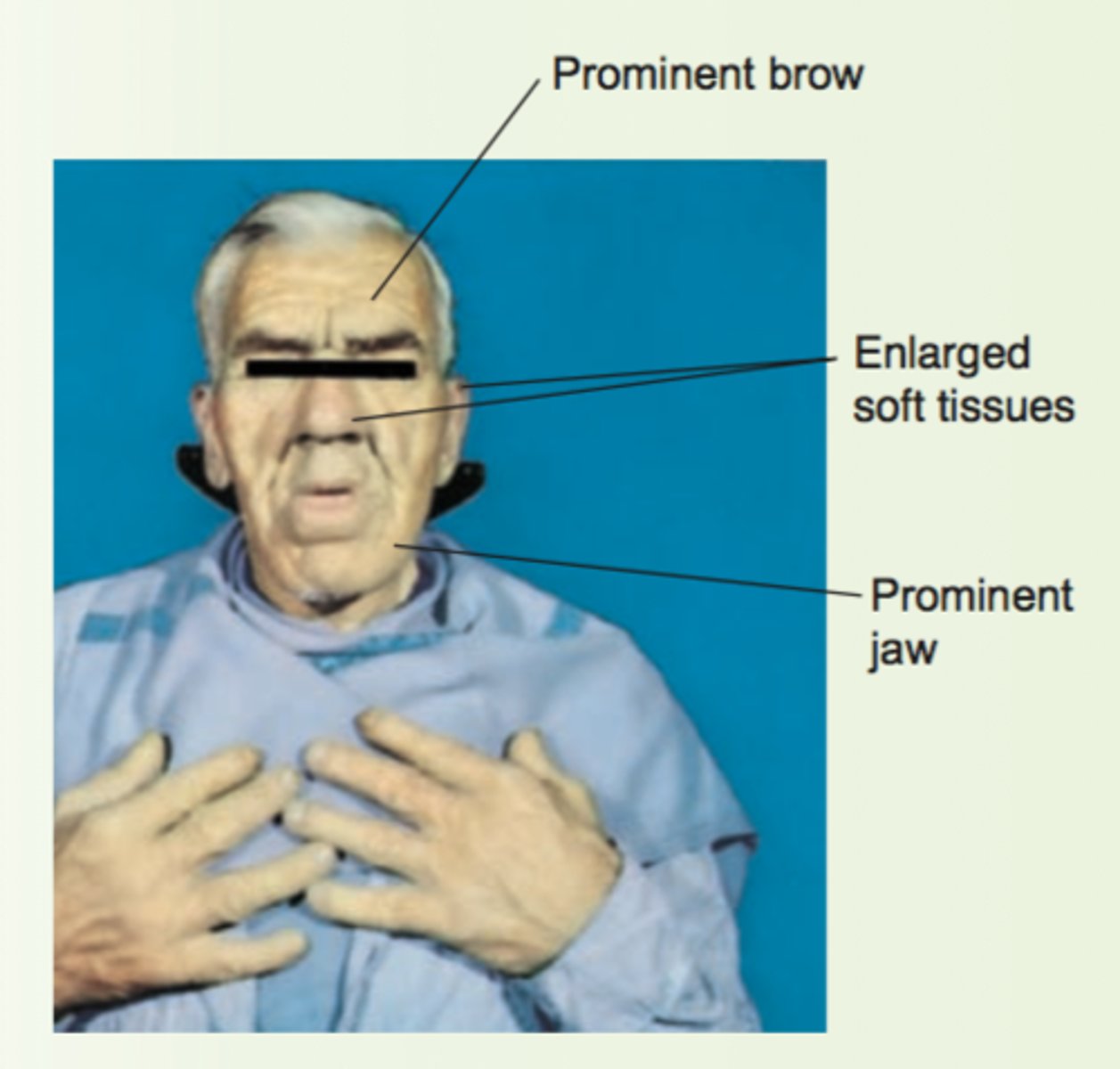 <p>enlargement of both bone and soft tissues. head is elongated with bony prominence over forehead, nose, and lower jaw. nose, lips, and ears also enlarge.</p>