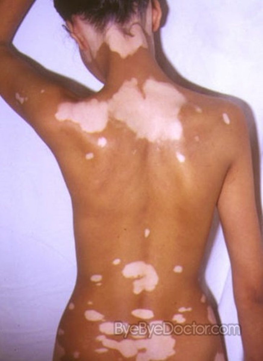 <p>Depigmented macules appear on the face, hands, feet, extensor surfaces, and other regions and may coalesce into extensive areas that lack melanin <br><br><b>Brown pigmentation is the normal skin color whereas the pale areas are vitiligo</b></p>