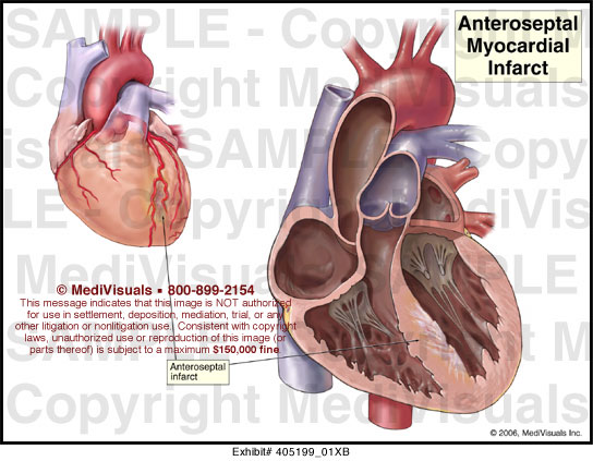 <p><strong>Anteroseptal infarction,</strong> indicative of an <strong> left anterior descending artery (LAD) </strong>occlusion affecting the basal part of the septum.</p>