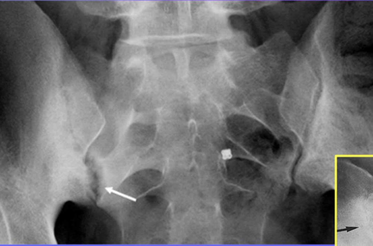 <p>Similar to AS, indistinct articulations</p><p>BUT...AP view identifies thick, nonmarginal syndesmophytes</p><p>For psoriatic arthritis, SI joint is usually not the first sign, and it is usually asymmetrical</p>