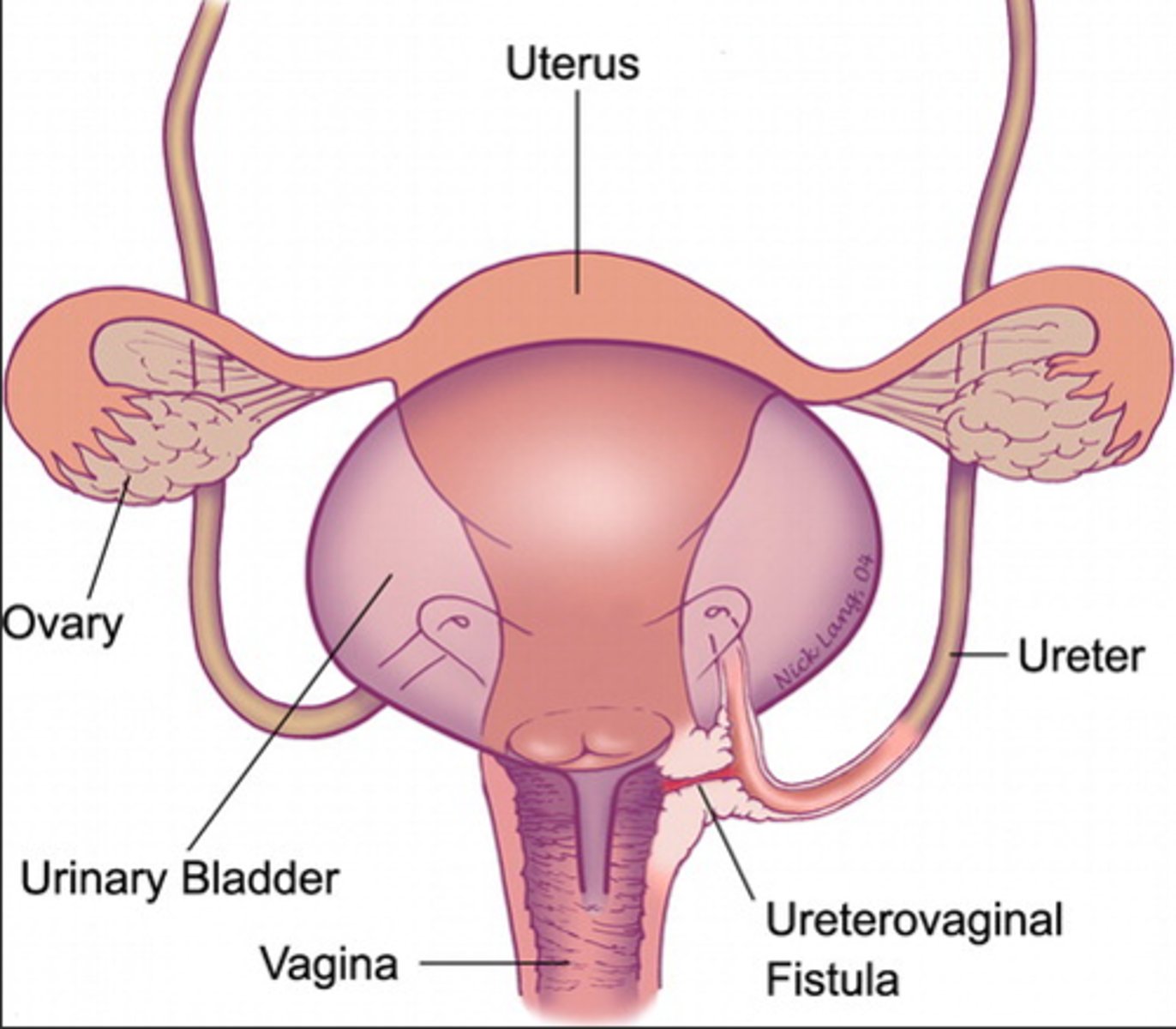 <p>a fistula between the lower ureter and vagina</p>