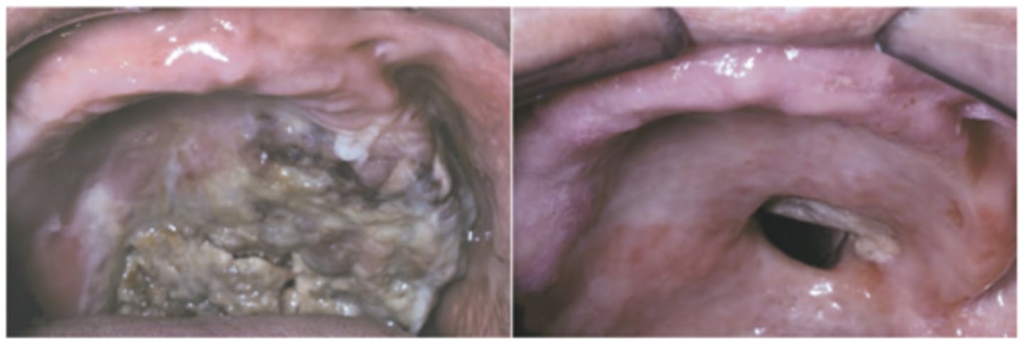 <p>Hint: midline swelling of soft palate may precede deep, necrotic ulcer</p>