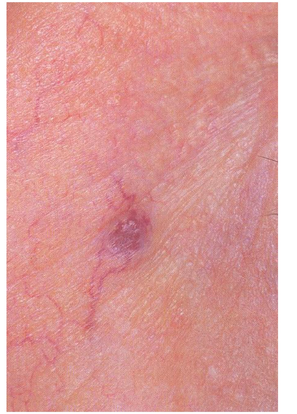 <p>what type of skin lesion is this? </p>
