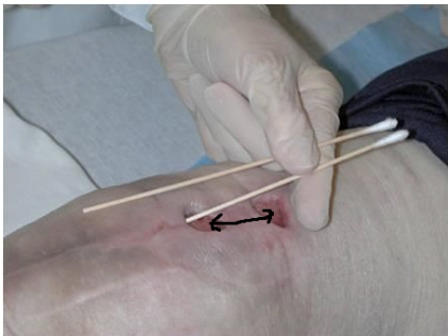 <p>a wound with an entrance and exit site</p>