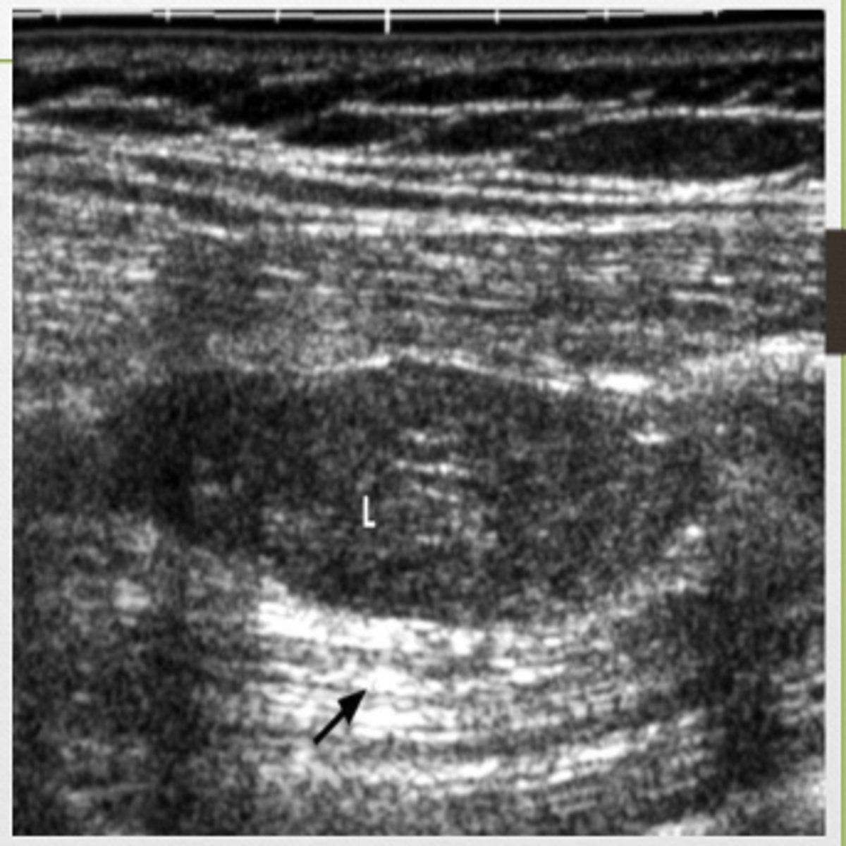 <p>Describe the structure labeled L in comparison to the surrounding tissue?</p>