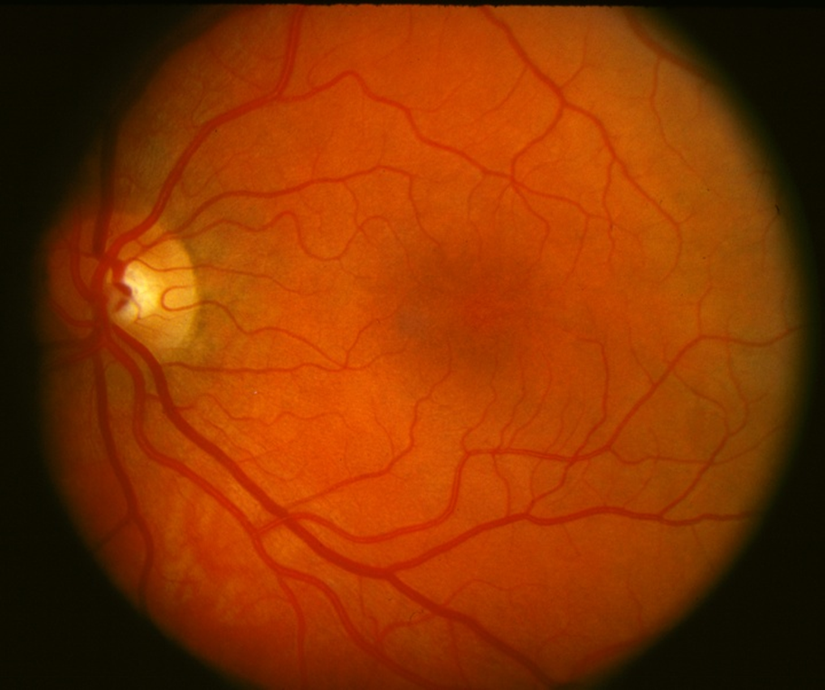 NORMAL retina