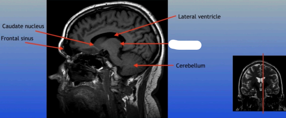 <p>A large mass of gray matter located in the diencephalon, acting as a relay station for sensory information and playing a key role in regulating consciousness and sleep. </p>