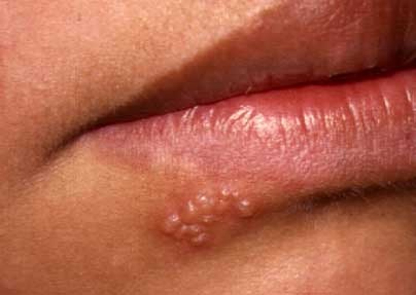 <p>fluid-filled lesions</p><p>&lt;1 cm</p>
