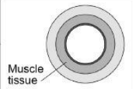 <p>Thick walls, narrow lumen</p><p></p>
