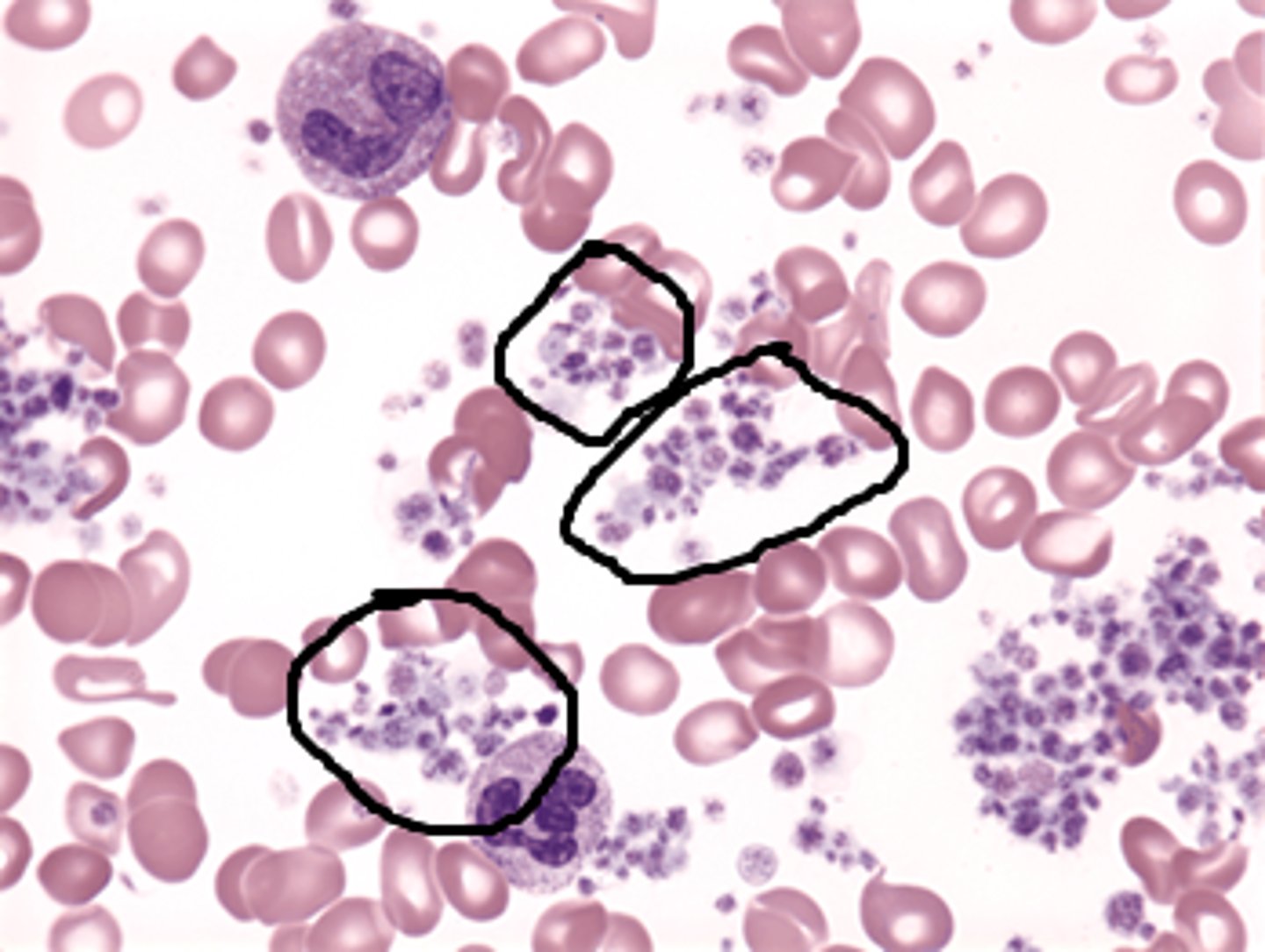 <p>abnormally high platelet count</p>
