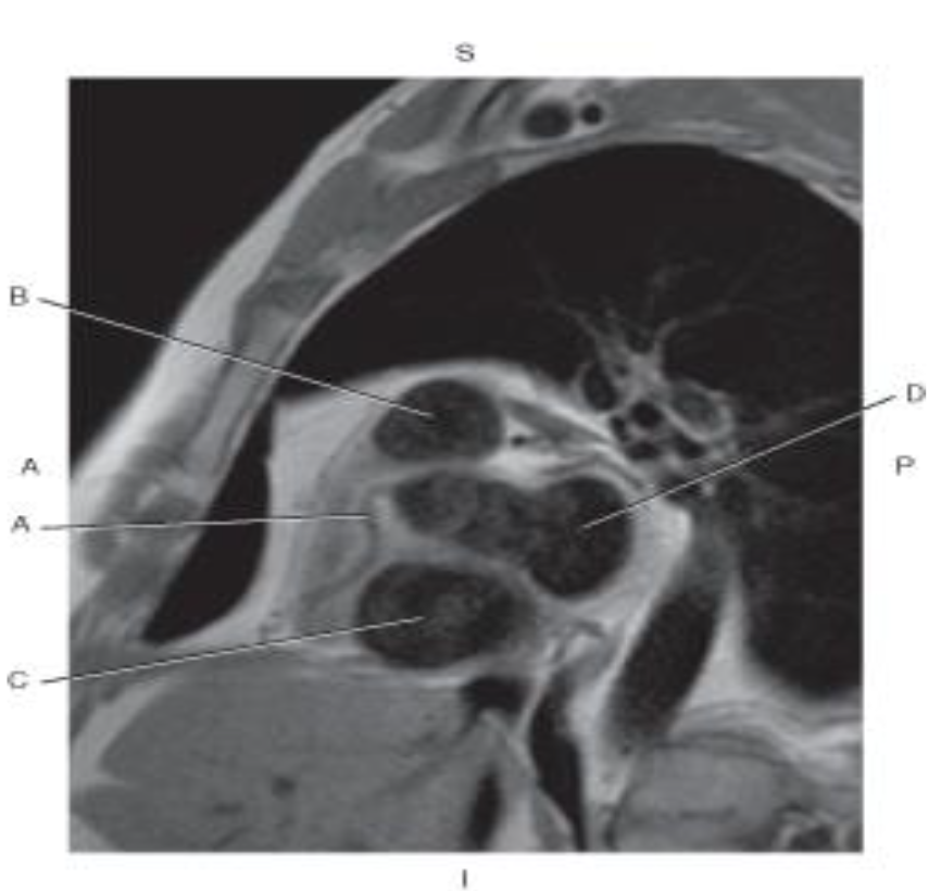 <p>Which line points to the<span style="color: green"> pulmonary trunk?</span></p>