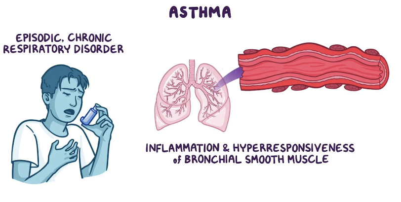 <p>Asmta är en kronisk inflammatorisk sjukdom i luftvägarna som leder till reversibel eller irevversibel obstruktion. </p><p>Det kan ge besvär såsom hosta, pip i bröstet, andfåddhet och liknande. </p>
