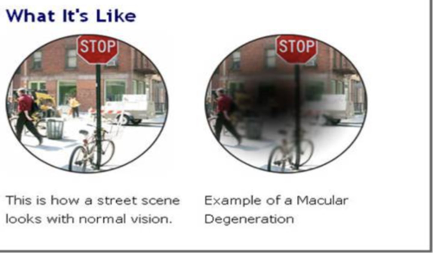 <p>no pain</p><p>drusen</p><p>blurred central vision</p>