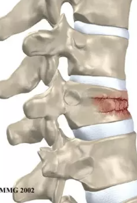 <p><strong>a type of broken bone that can cause your vertebrae to collapse, making them shorter</strong><span style="font-family: Google Sans, Roboto, Arial, sans-serif">.</span></p>