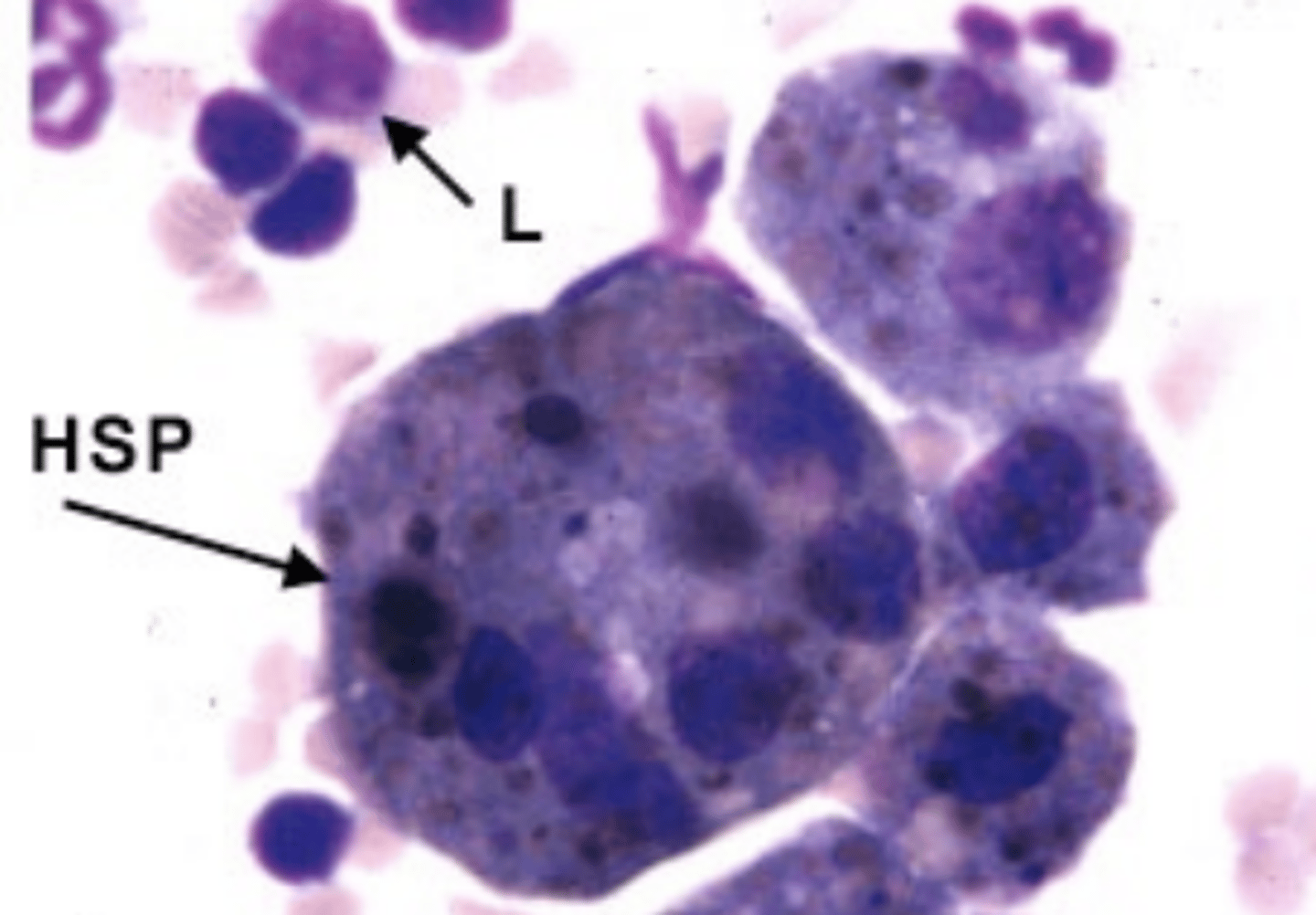 <p>- PE</p><p>- Endoscopy (30-120 mins after exercise)</p><p>- BAL (Macrophages with hemosiderin inside = Hemosiderophages)</p>